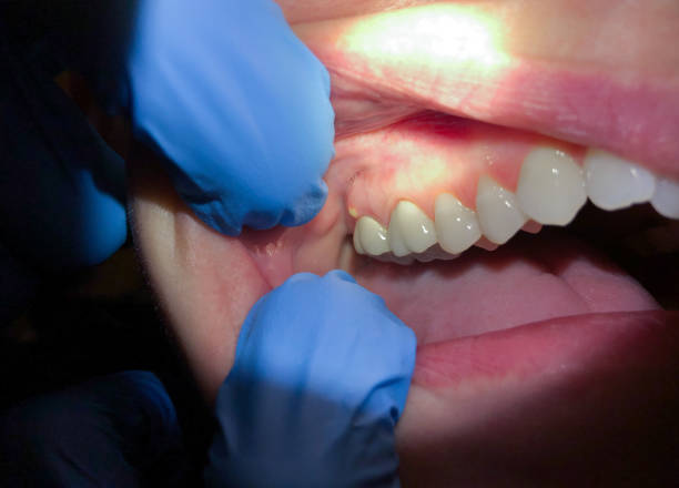Best Emergency Dentist for Lost Fillings or Crowns in La Palma, CA